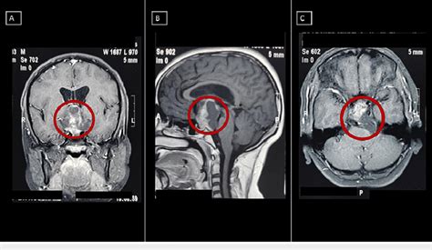 Preoperative contrast-enhanced MRI A: Preoperative contrast-enhanced ...