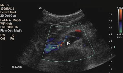 Doppler Ultrasound Showing Nutcracker Phenomenon Narrowing Download Scientific Diagram