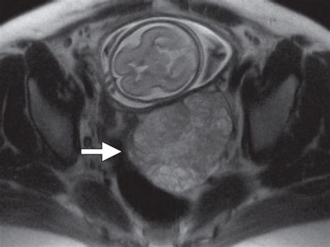 Mr Imaging Findings Of Ectopic Pregnancy A Pictorial Review Radiographics