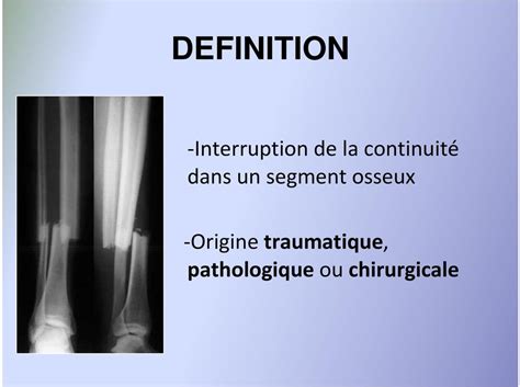 Fractures de l adulte Généralités Sébastien TOMES Service de