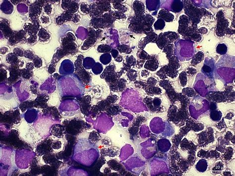 Bone Marrow Aspirate Shows Monocytic Hyperplasia Red Arrows With The