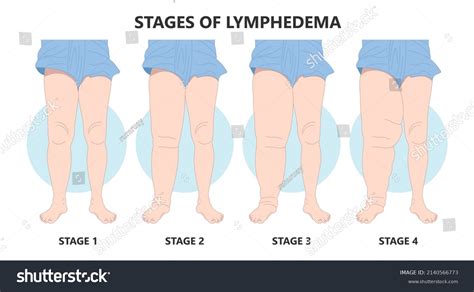 Syndrome Milroy Leg Edema Venous Deep Stock Vector (Royalty Free ...