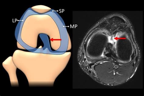 Infrapatellar Plica Ligamentum Mucosum Eurorad