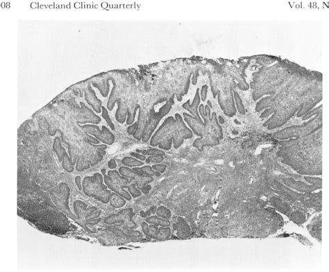 Figure 1 From Verrucous Squamous Cell Carcinoma Of The Vagina Case