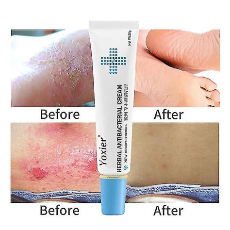 20g Skin Rash Cream Eczema Ointment Anti-fungal Cream Psoriasis Treatm ...