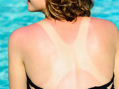 Intentional Sunburn Has Gen Z Missed The Sun Safety Memo The