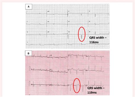 (A) Admission electrocardiogram showing evidence of junctional escape ...