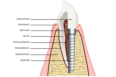 Bone Level Oder Tissue Level Welches Implantat Ist Besser