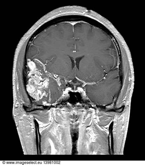 Temporal Lobe AVM on MRI Temporal Lobe AVM on MRI,abnormal,abnormality,arterial venous ...