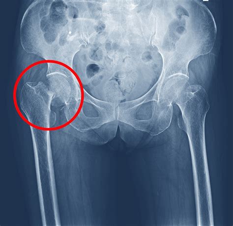 Qu Hacer Ante Una Fractura De Cadera S Ntomas Y Causas Cinfasalud Hot