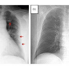 Chest Radiographs Of The Patient A Chest Radiograph On Presentation