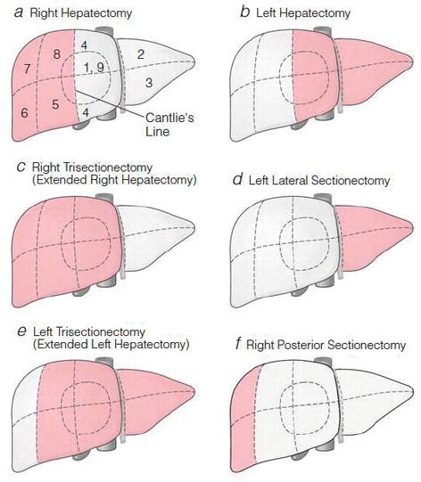 Surgical Resection In HCC IntechOpen