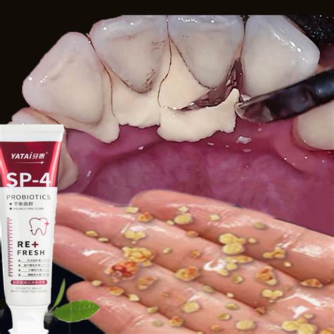 Teeth Sp Whitening Pemutih Gigi Original Probiotic Toothpaste