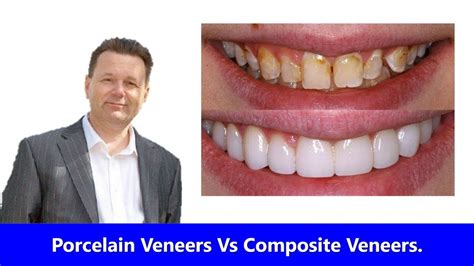 Porcelain Veneers Vs Composite Veneers Which Is Best Youtube