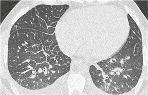 The Radiology Assistant : Chest X-Ray - Heart Failure