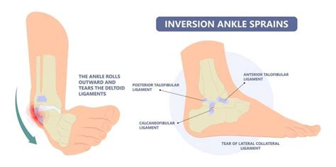 How and Why Does Inversion Ankle Sprain Affect Athletes