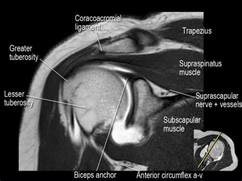 Shoulder Mri Anatomy Labeled