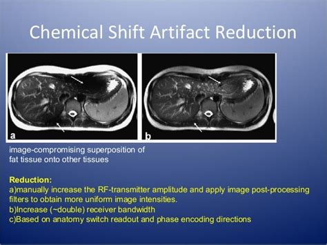 Distortion Artifacts In Mri And Their Correction