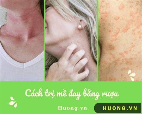 6 Cách Trị Mề đay Bằng Rượu Tại Nhà Hiệu Quả Hươngvn