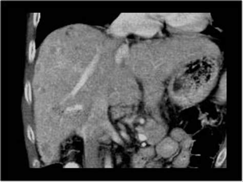 Abdomen And Retroperitoneum 1 1 Liver Case 1 1 16 Miscellaneous