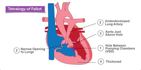 Tetrology Of Fallot Panacea Mk