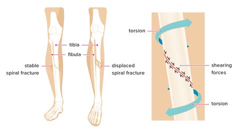 Spiral Fracture Healing Time Tibia And Fibula