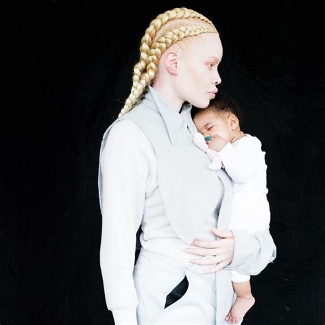 Stunning Model With Albinism Expands The Definition Of Beauty