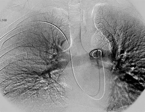 Cirse 2014 Hybrid Treatment With Angiographic Catheter In Massive Pulmonary Embolism