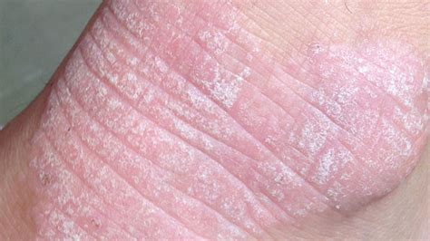 Dermatitis Herpetiformis Causes Symptoms And Diagnosis