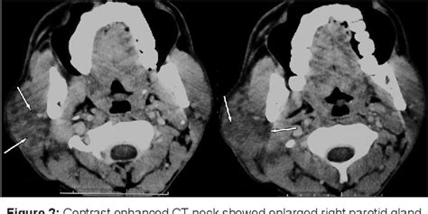 Figure 1 From Tuberculosis Of Parotid Gland Masquerading Parotid