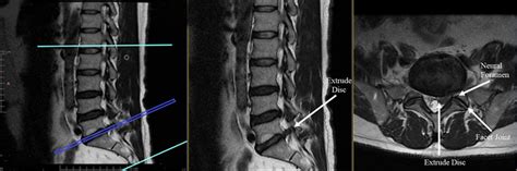 T2 sagittal and axial sections of L5-S1 of a patient in the ...