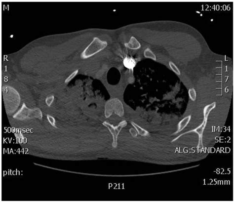 Fat Embolism Syndrome After Nailing An Isolated Open Tibial Fracture In