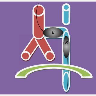 Illustration of fistula isolation with Fogarty catheter B: Fogarty ...