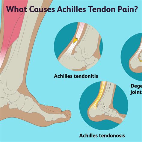 Leg Tendon Pain Physical Therapy Guide To Peroneal Tendinopathy