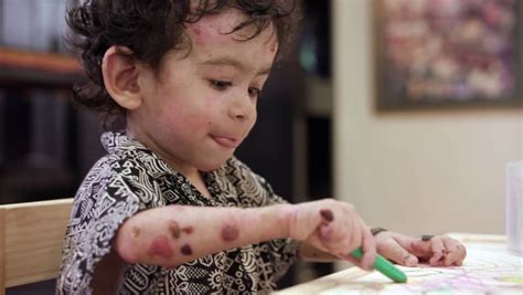 Singapores Butterfly Children Born With ‘the Worst Disease Youve