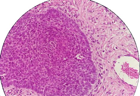 Polygonal Basaloid Cells With Dark Hyperchromatic Ovoid Uniform Nuclei