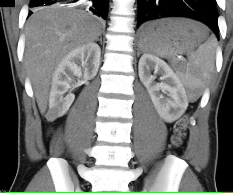 Muscle And Soft Tissue Metastases From Renal Cell Carcinoma Kidney