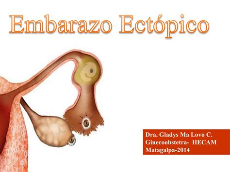 Embarazo Ectopico Ppt