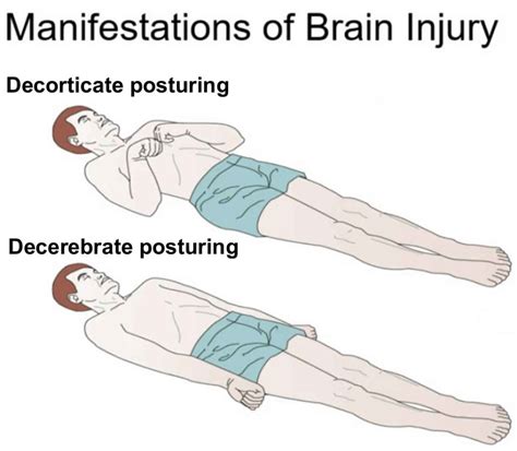 Decorticate And Decerebrate Posturing Causes And Treatment