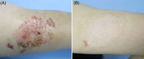 Application Of 5‐aminolevulinic Acid‐photodynamic Therapy In Common Skin Diseases Shi 2020