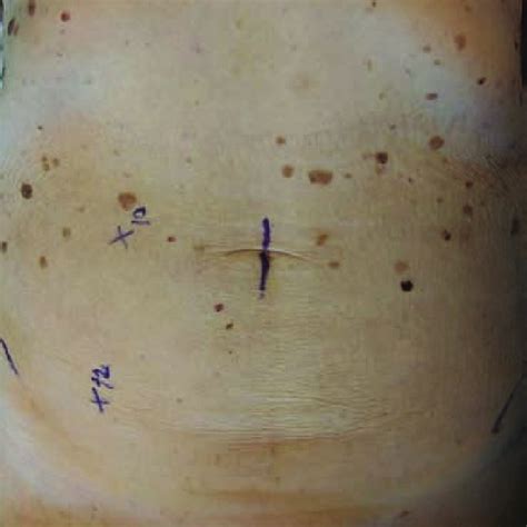 Hand Port Incision And Port Positions For Sigmoid Colectomy And