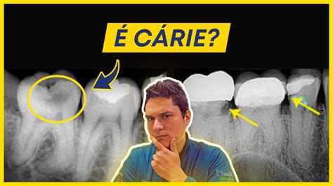 Como Identificar Carie No Raio X - Como Identificar uma Cárie na Radiografia? - YouTube