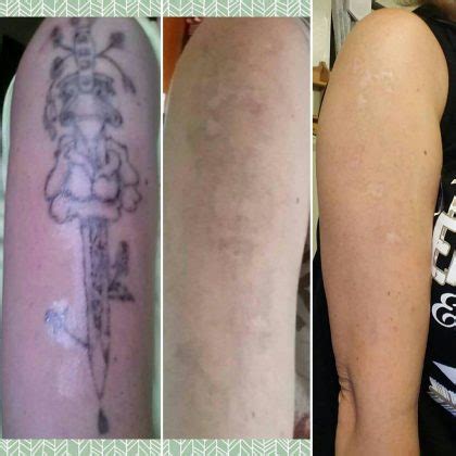 dermabrasion tattoo removal before and after - Jamison Sibley