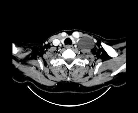 Lymphangioma Of The Neck Image Radiopaedia Org