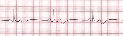 Sinus Bradycardia ECG/EKG NCLEX Quiz, 53% OFF