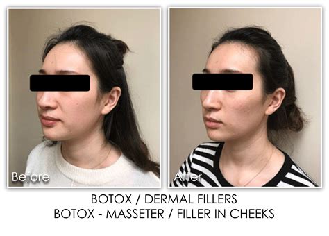 Botox And Dysport Archives Page 2 Of 2 Skin Rejuvenation Clinic