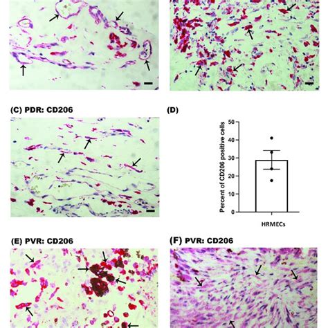 Identification Of CD68 CD206 Double Positive Cells In Epiretinal