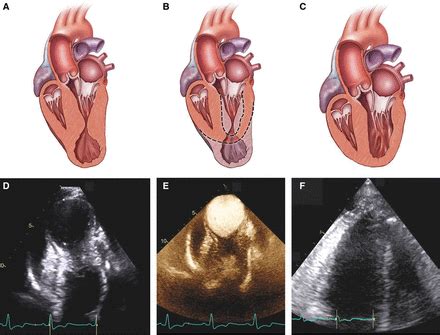 Early Outcomes Of Repair Of Left Ventricular Apical Aneurysms In