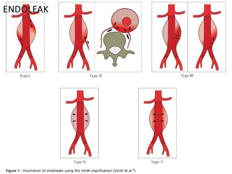 Endoleak