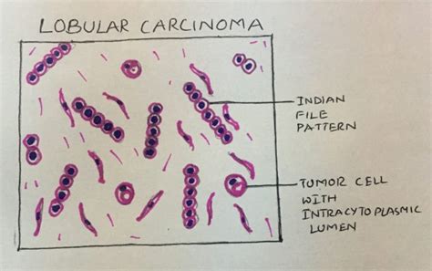 Invasive Lobular carcinoma. – Histopathology.guru